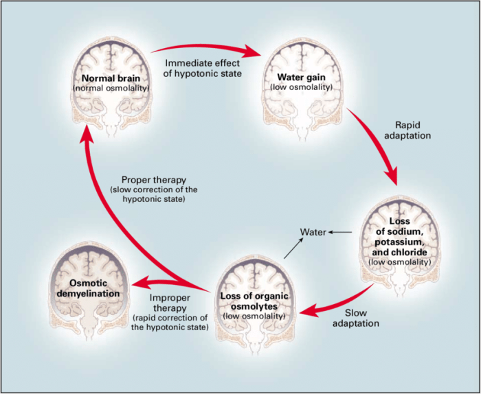 How is brain tissue different from other tissues during hyponatremia