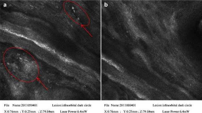 The greatest concentration of melanin is in the dermis