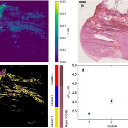 The greatest concentration of melanin is in the dermis