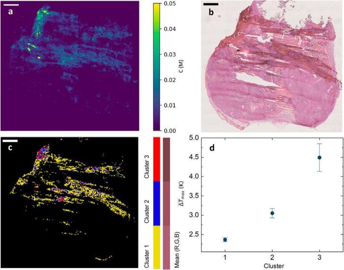 The greatest concentration of melanin is in the dermis